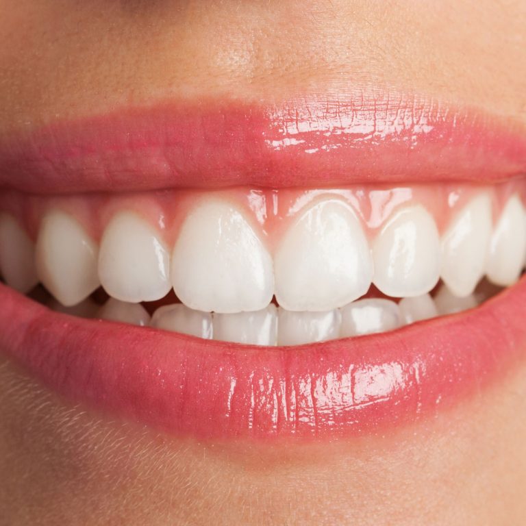 Diş Estetiği (Hollywood Smile) Tedavileri