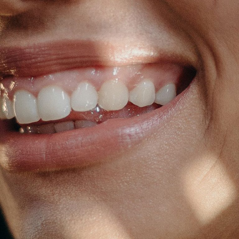 gummy-smile-header